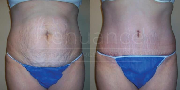 Before and after image showing a woman's abdomen. The left side (before) shows a woman with loose skin and stretch marks. The right side (after) shows the same woman with tightened skin and a more toned appearance. Both images show the woman wearing a white top and blue bottoms.
