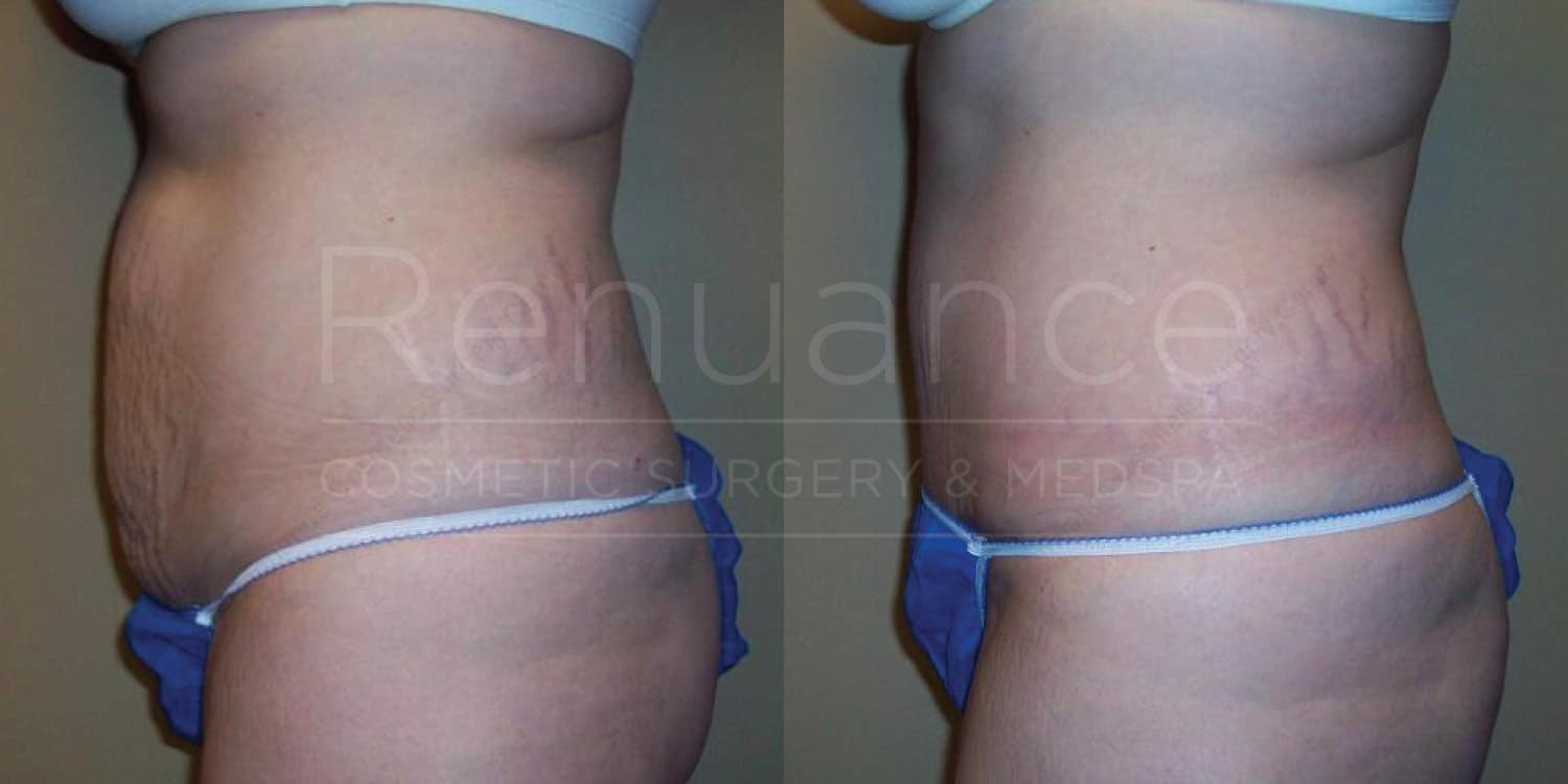 Side-by-side comparison of a woman's torso, showing a before-and-after effect of a medical or cosmetic procedure. The left image shows the body with a noticeable amount of excess skin and fat. The right image shows a more toned and slimmer appearance with reduced skin fold and fat. The words "Renuance Cosmetic Surgery & MedSpa" are overlayed on the images.