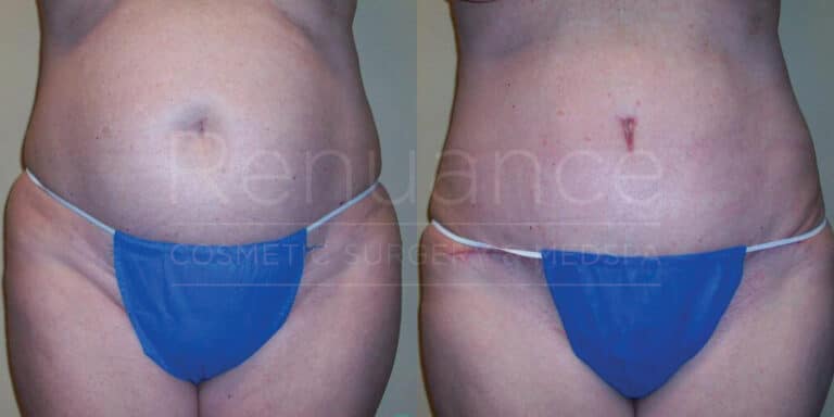 Before and after images of a person's abdominal area. The left image shows a belly with more prominent fat distribution. The right image shows a flatter, more contoured abdomen with a visible medical scar, indicating a surgical or cosmetic procedure. Both images feature the individual wearing blue underwear. Text on the image reads "Renuance Cosmetic Surgery Center MedSpa."