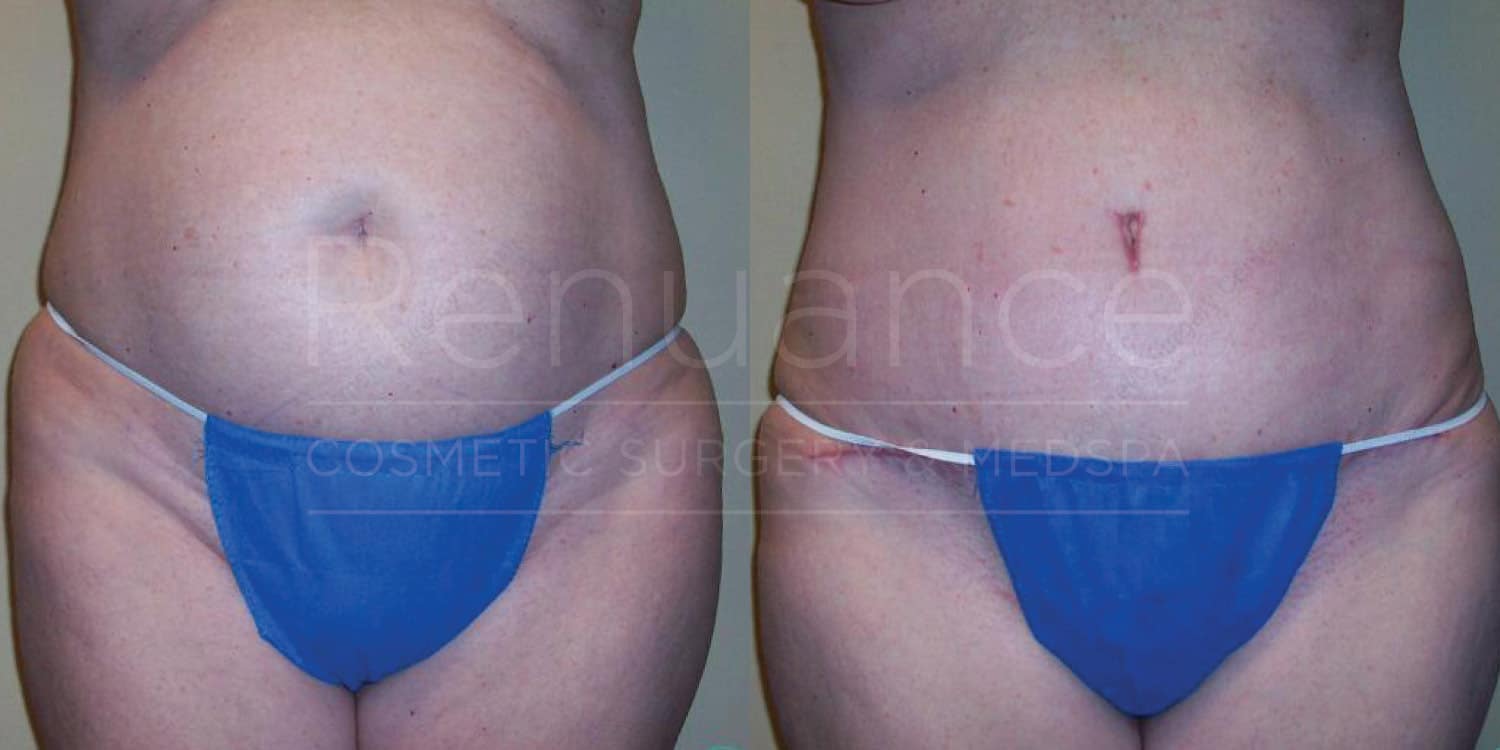 Before and after images of a person's abdominal area. The left image shows a belly with more prominent fat distribution. The right image shows a flatter, more contoured abdomen with a visible medical scar, indicating a surgical or cosmetic procedure. Both images feature the individual wearing blue underwear. Text on the image reads "Renuance Cosmetic Surgery Center MedSpa."