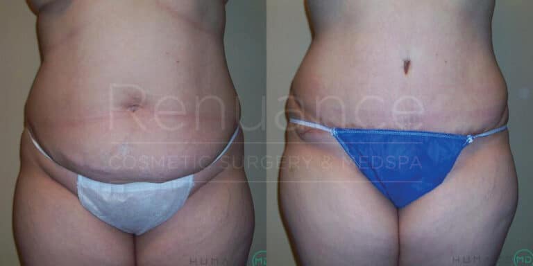 A side-by-side comparison image showing a person's abdominal area before and after a cosmetic procedure. The left side depicts the person with a fuller midsection, while the right side shows a slimmer and more contoured midsection after the procedure. The text "Renuance Cosmetic Surgery & Medspa" is superimposed across the image.