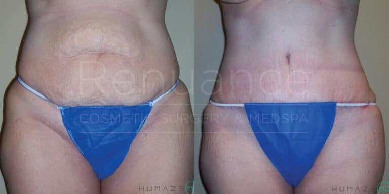 Two side-by-side images showing a person's abdomen before and after a cosmetic procedure. In the "before" image on the left, the person has visible skin sagging and wrinkles. In the "after" image on the right, the person’s abdomen appears tighter and smoother. The person is wearing blue undergarments in both images.