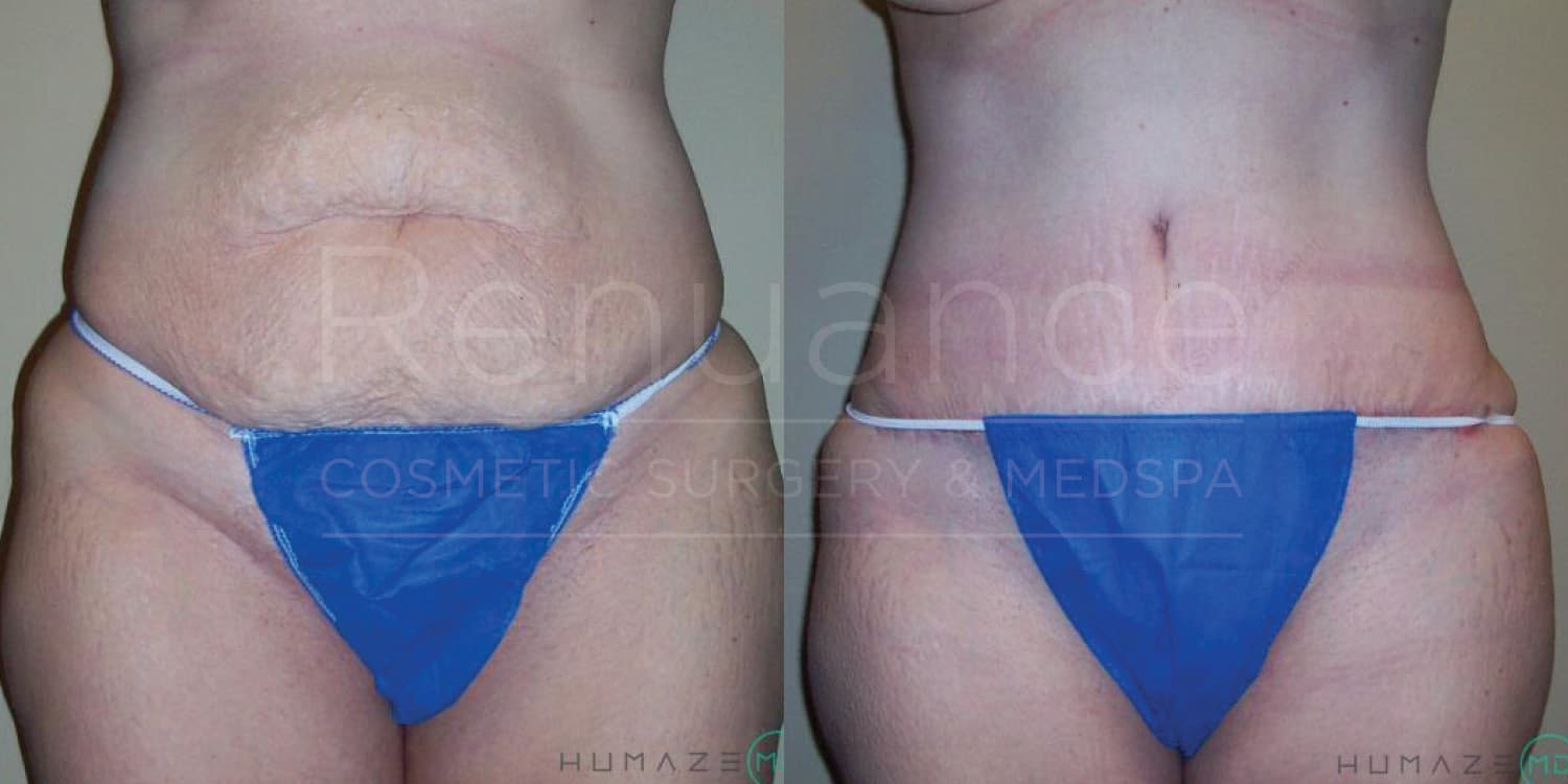Two side-by-side images showing a person's abdomen before and after a cosmetic procedure. In the "before" image on the left, the person has visible skin sagging and wrinkles. In the "after" image on the right, the person’s abdomen appears tighter and smoother. The person is wearing blue undergarments in both images.
