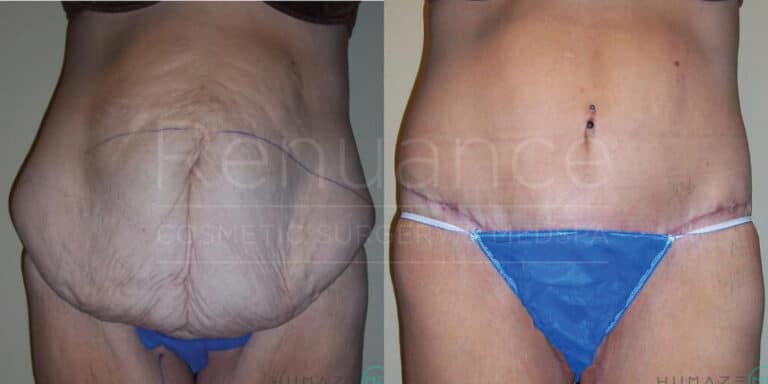 Before and after images showing the results of an abdominoplasty (tummy tuck) procedure. In the left image, a person has loose and sagging abdominal skin with marking lines. In the right image, the same person has a flatter and more toned abdomen with significantly reduced sagging and skin tightening, wearing blue underwear and a belly button piercing.