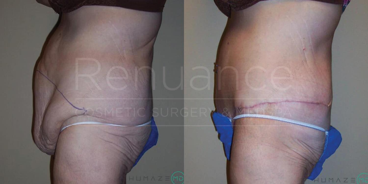 Before and after image of a person who has undergone cosmetic surgery. The left side shows the person before the surgery, with excess sagging skin around the lower abdomen. The right side shows the same person after the surgery, with tightened and smoother skin in the same area. The person is wearing a blue garment on the bottom part of their body.