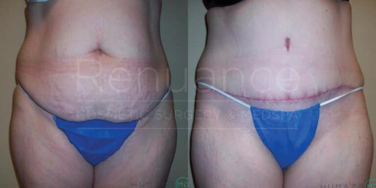 Alt text: A side-by-side comparison of a person's abdomen before and after cosmetic surgery. The left image shows a person with a larger belly, while the right image shows the same person with a flatter, more toned abdomen and a surgical scar, indicating they have undergone a procedure. The person is wearing blue undergarments in both images.