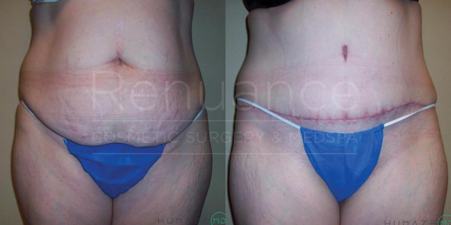 Alt text: A side-by-side comparison of a person's abdomen before and after cosmetic surgery. The left image shows a person with a larger belly, while the right image shows the same person with a flatter, more toned abdomen and a surgical scar, indicating they have undergone a procedure. The person is wearing blue undergarments in both images.