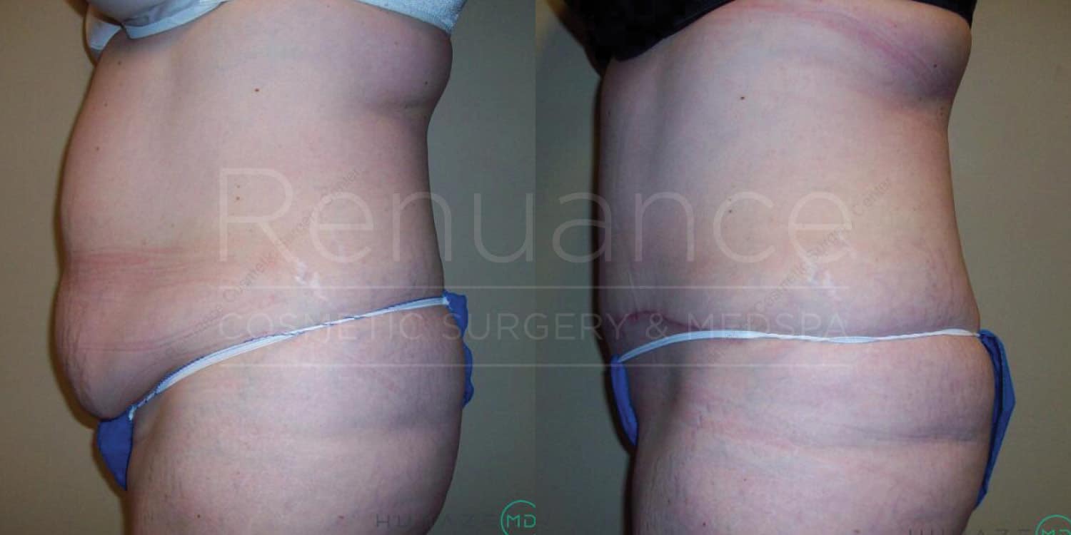A before-and-after photo showing the side profile of a person's torso. The left image depicts the person before undergoing a cosmetic procedure with a noticeable bulge in the lower abdomen. The right image shows the person after the cosmetic procedure, with a significantly flatter and more contoured abdomen. The words "Renuance Cosmetic Surgery & Medspa" are faintly visible over the images.