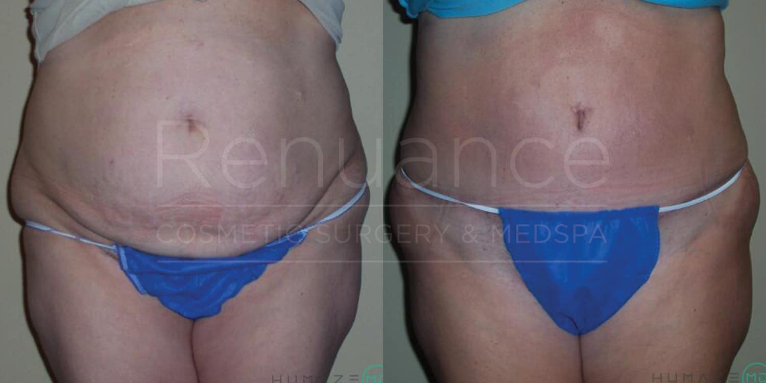 Professional tummy tuck before and after outcome