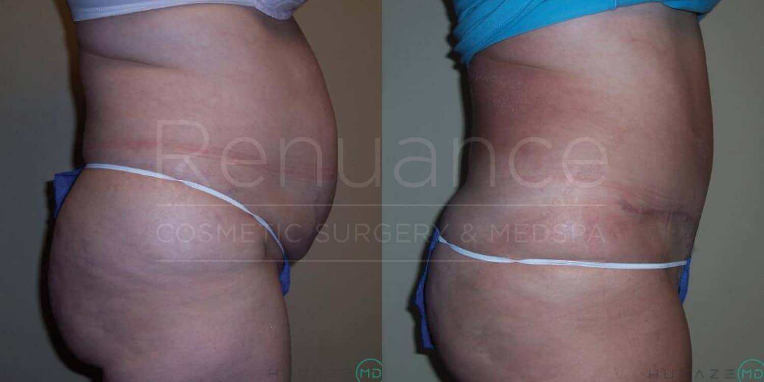 Before and after tummy tuck displaying aesthetic results