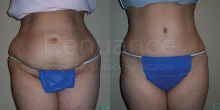 Tummy tuck before and after highlighting surgical success