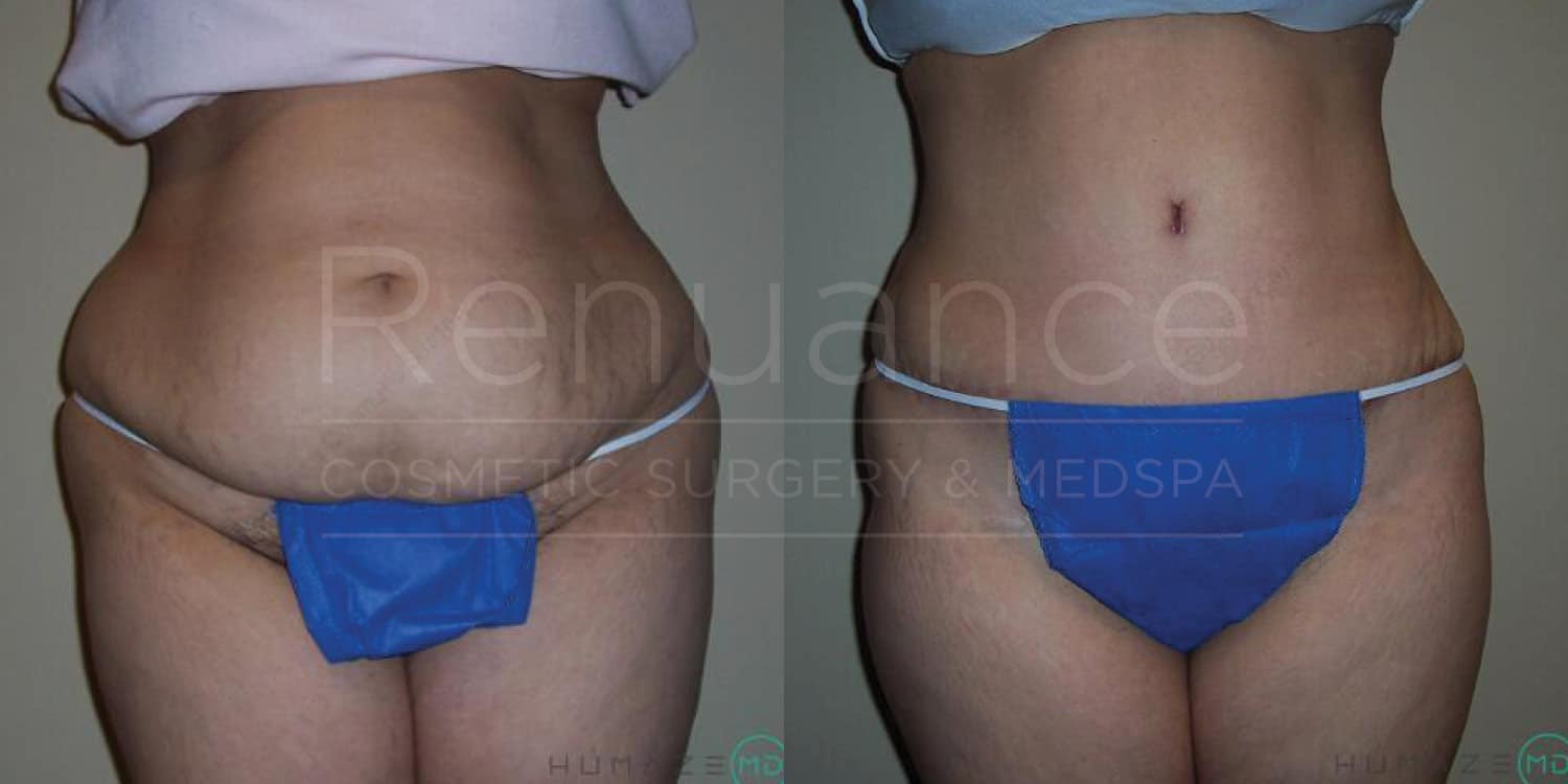 Tummy tuck before and after highlighting surgical success