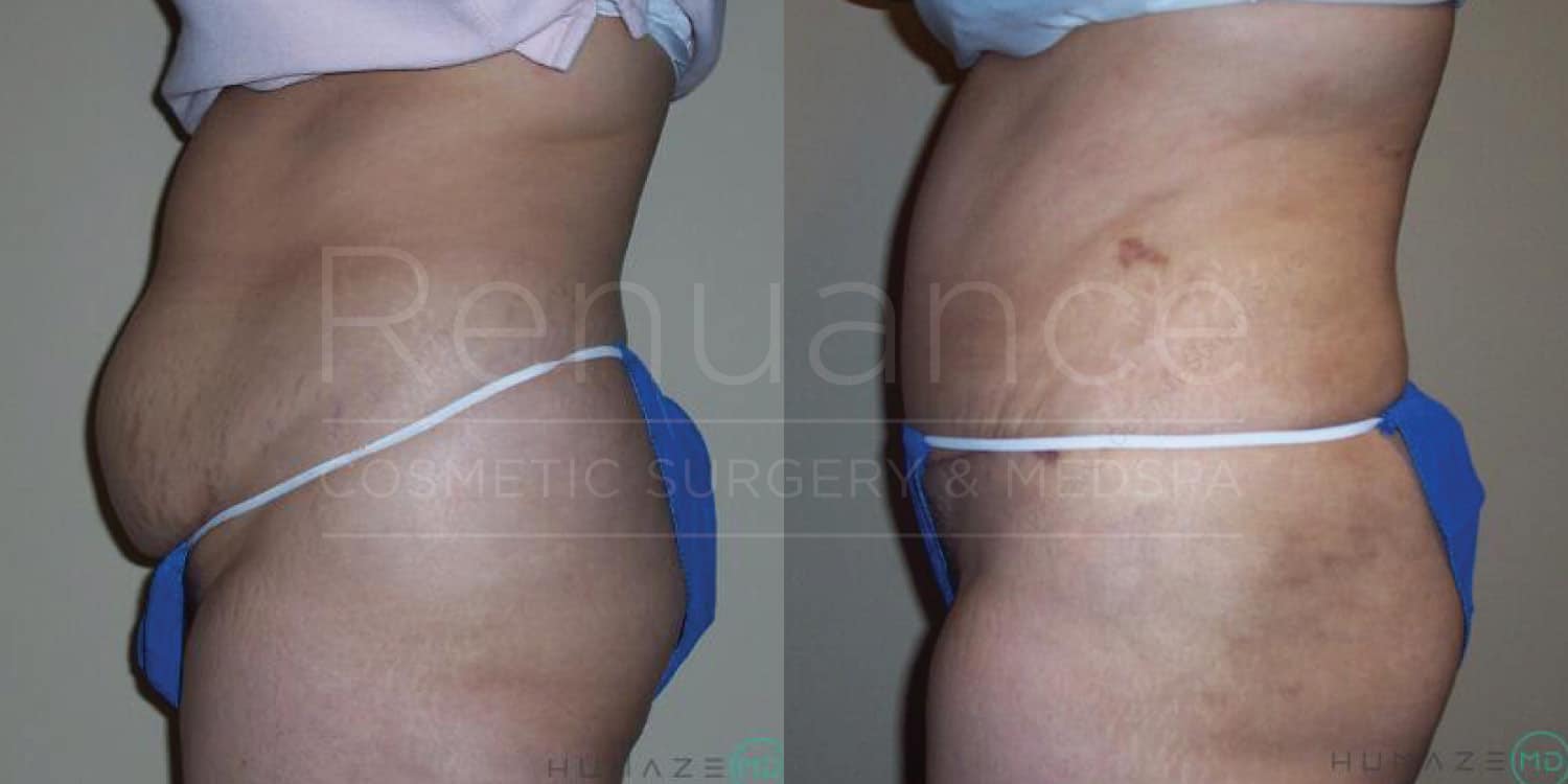 Before and after tummy tuck showcasing expert technique