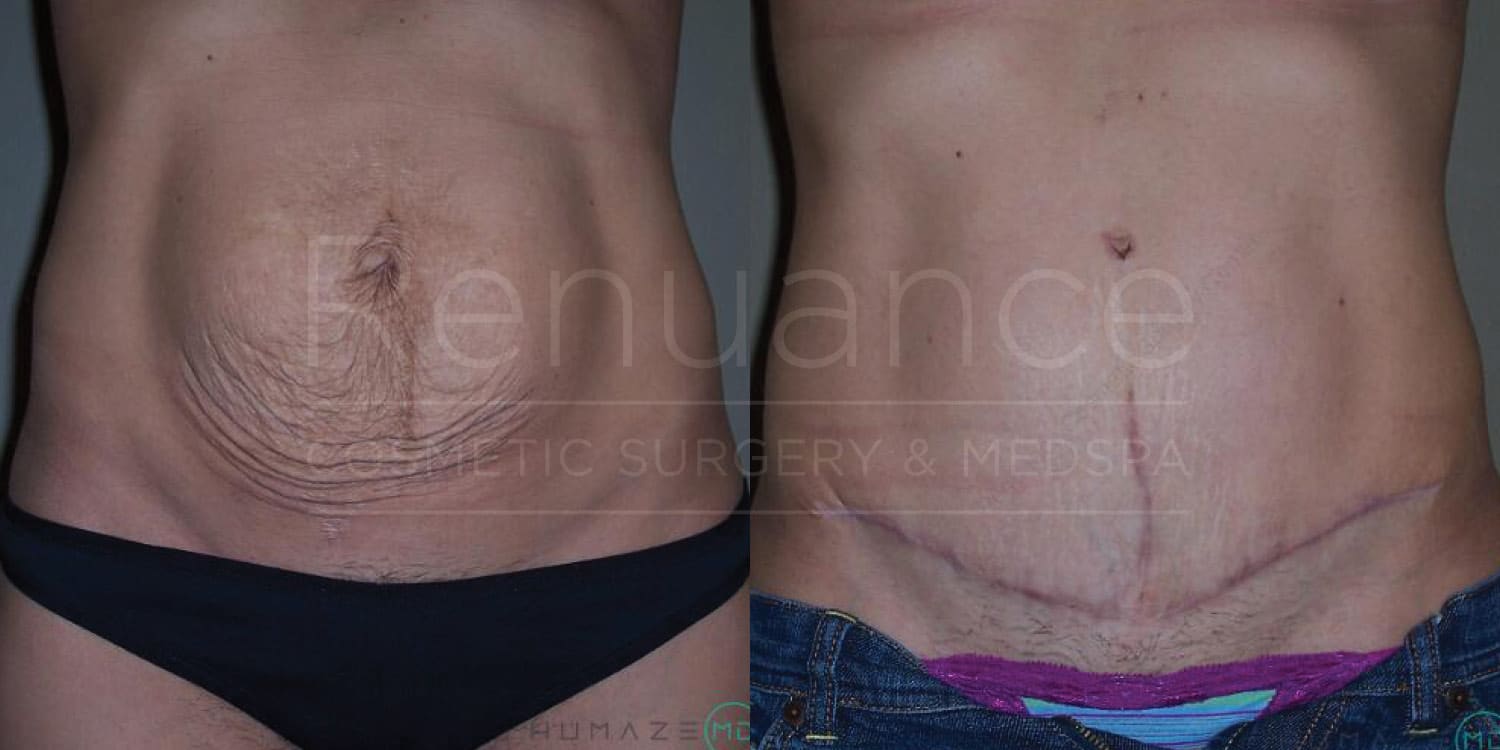 Before and after tummy tuck showing refined midsection