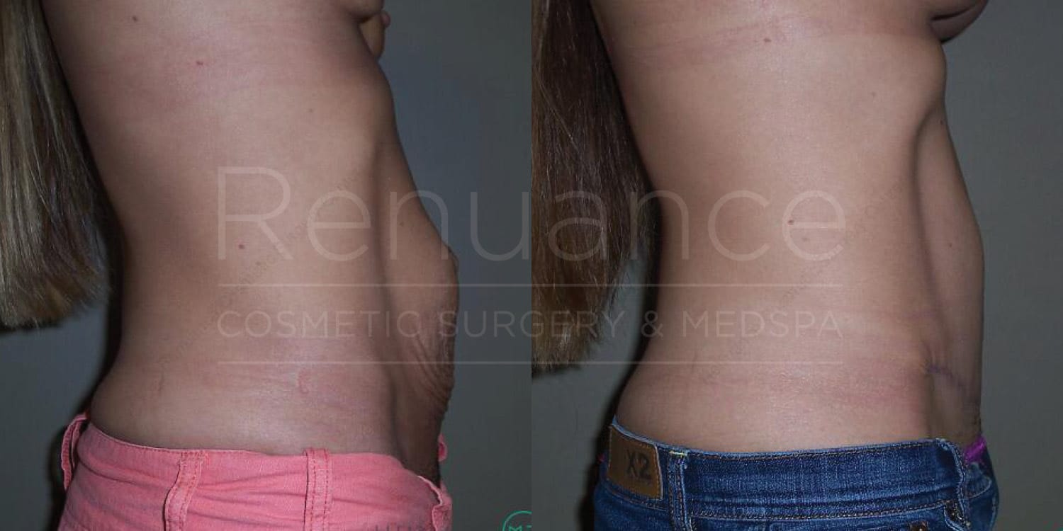 Before and after tummy tuck revealing smooth contours