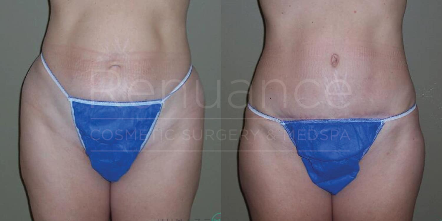 Before and after tummy tuck showing abdomen transformation