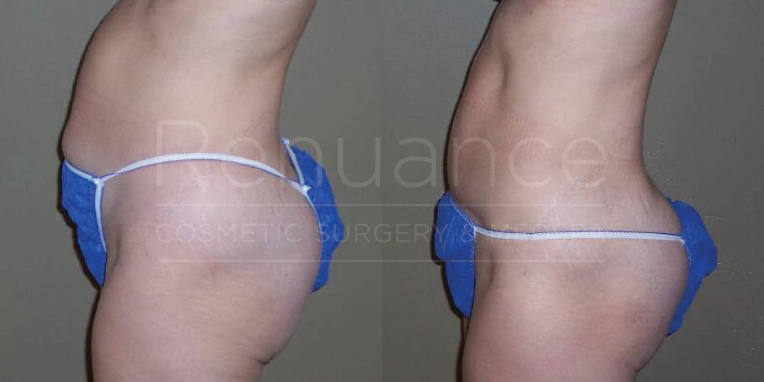 Standard tummy tuck before and after