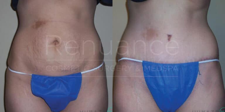 Before and after tummy tuck showing surgical outcome