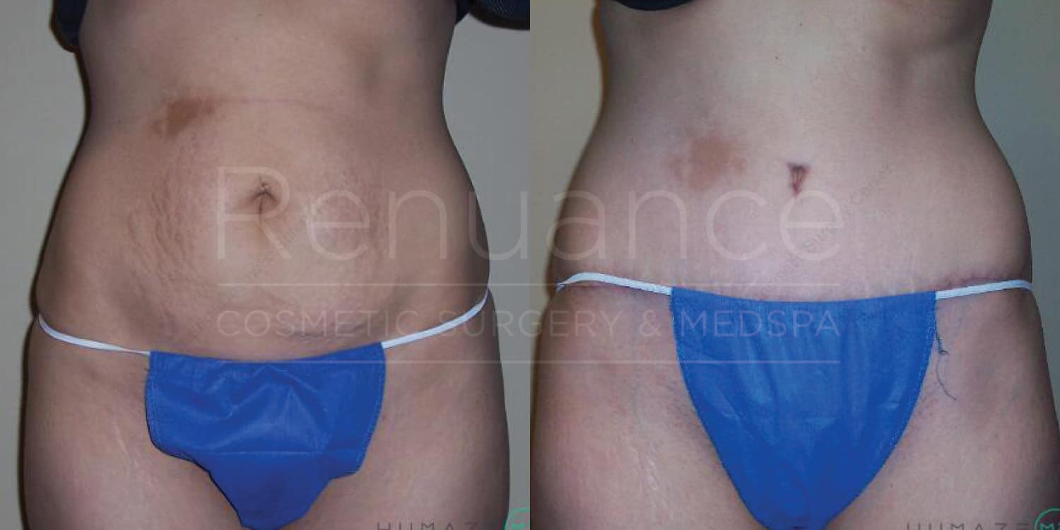 Before and after tummy tuck showing surgical outcome