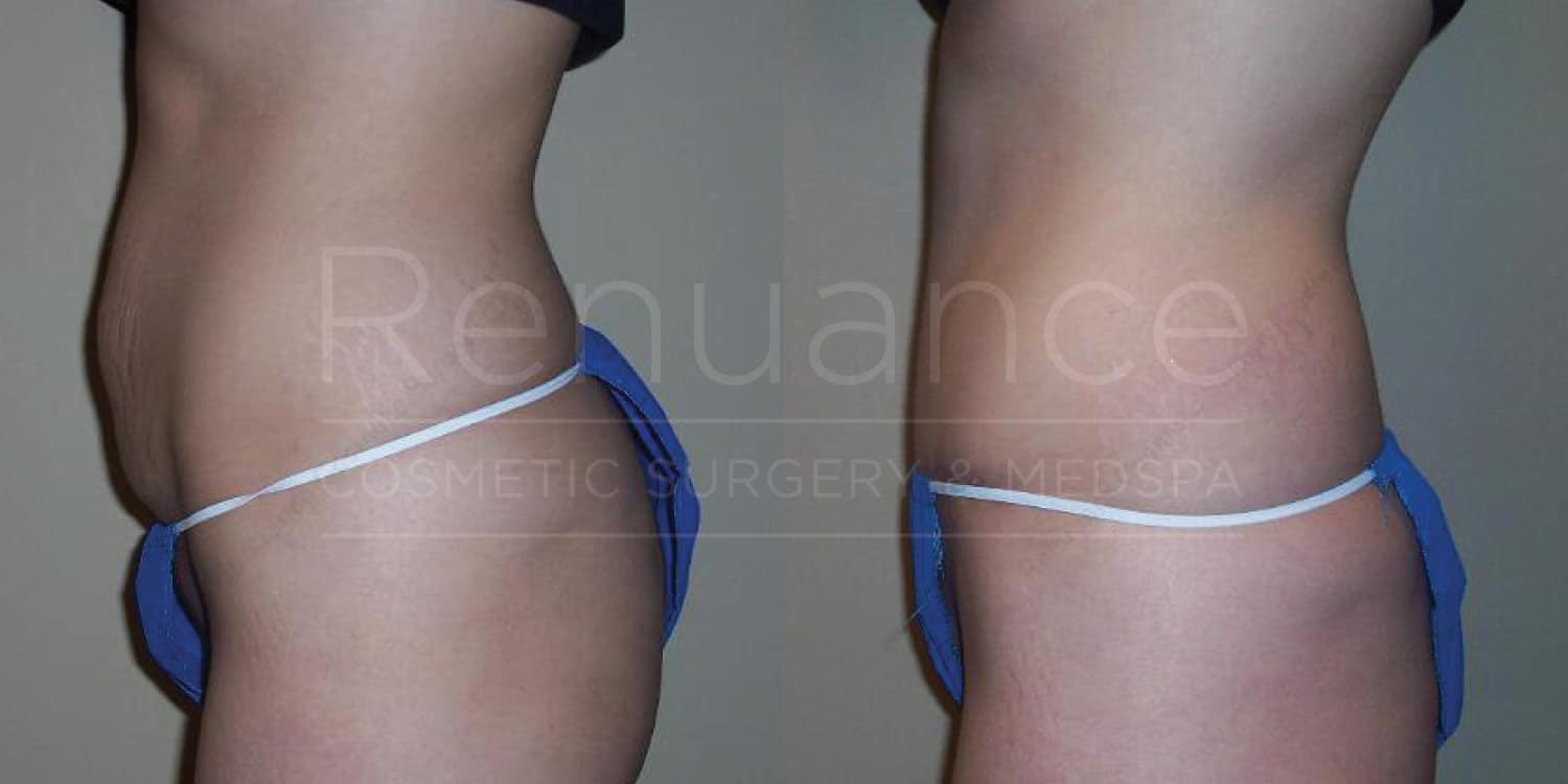 Modern tummy tuck before and after results