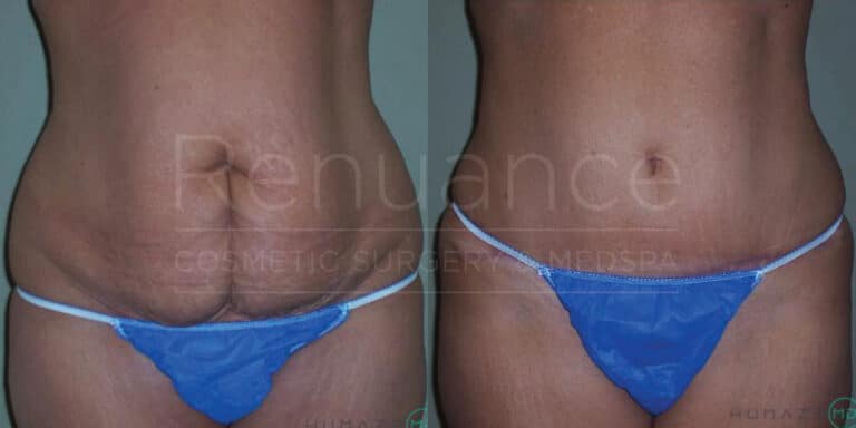 Before and after tummy tuck showing stomach recontouring