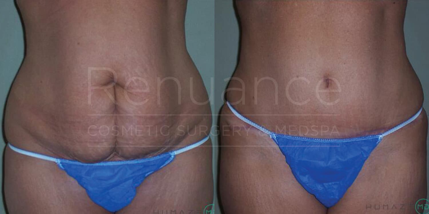 Before and after tummy tuck showing stomach recontouring
