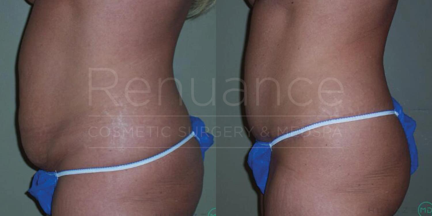 Detailed tummy tuck before and after results