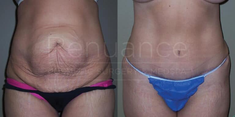 Before and after tummy tuck illustrating surgical results