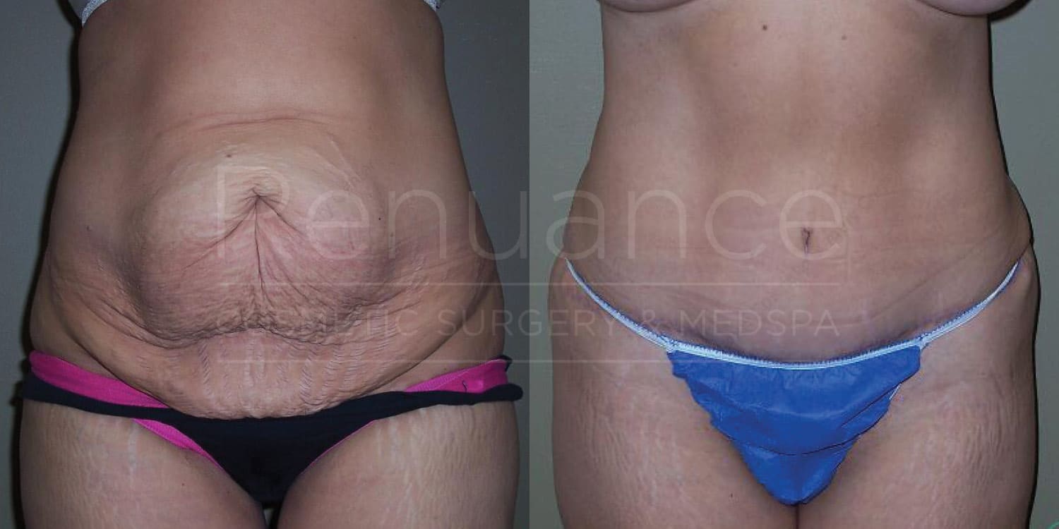 Before and after tummy tuck illustrating surgical results