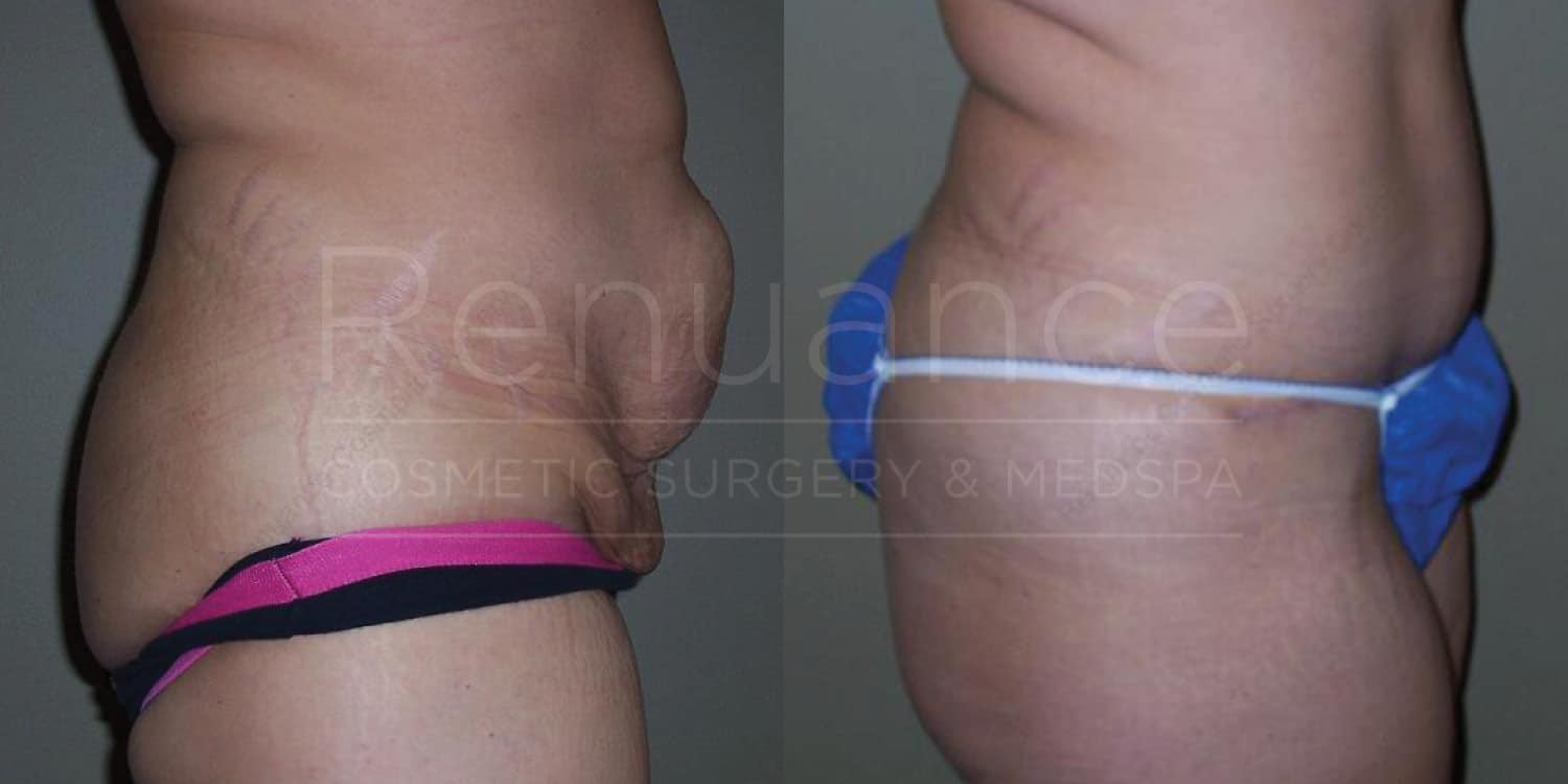 Quality tummy tuck before and after outcome