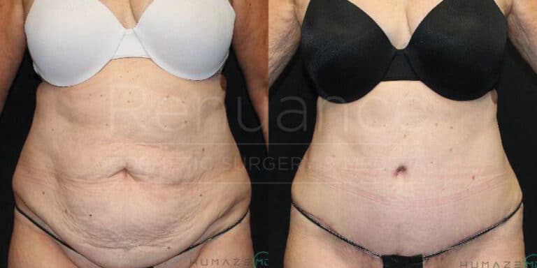 Latest tummy tuck before and after from our surgical suite