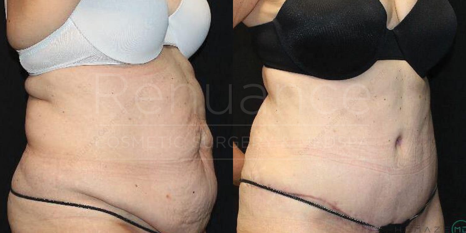 Before and after tummy tuck showing abdominal sculpting