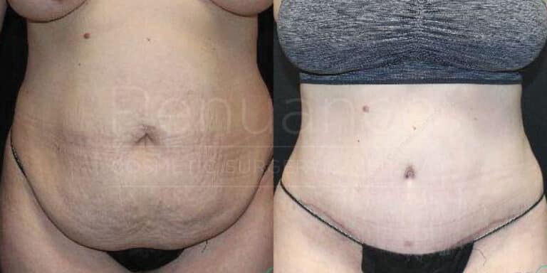 Tummy tuck before and after demonstrating core refinement