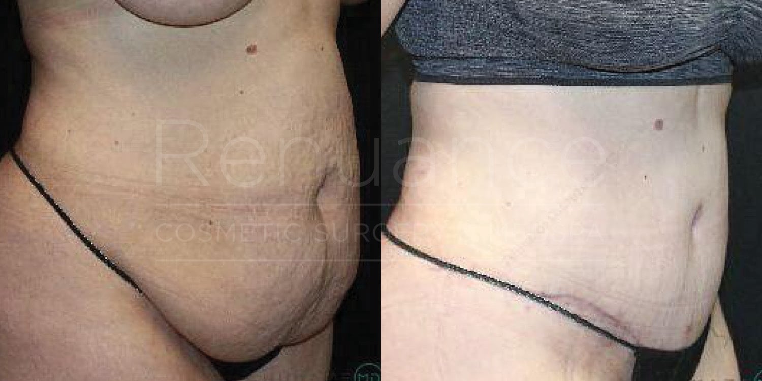 Before and after tummy tuck revealing natural-looking results