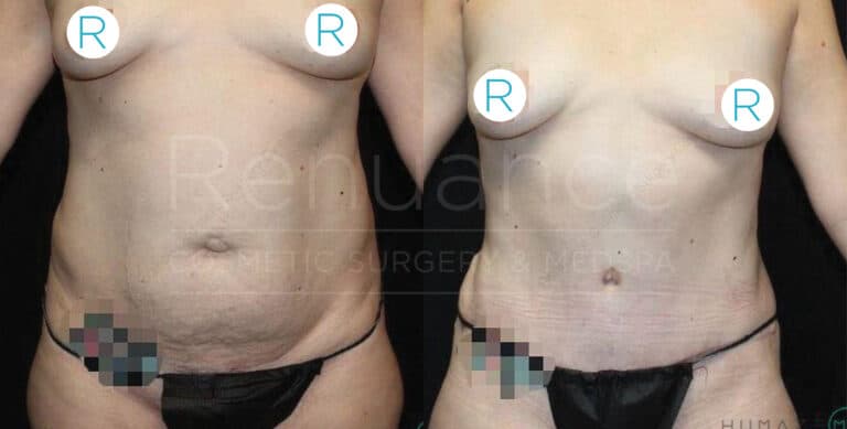 Before and after tummy tuck displaying surgical excellence