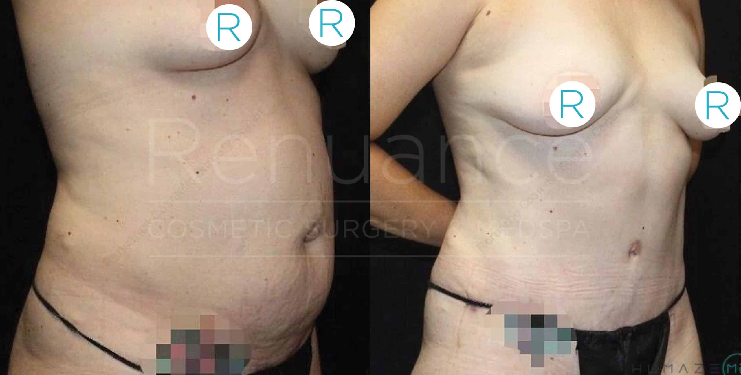 Before and after tummy tuck showing balanced body proportions