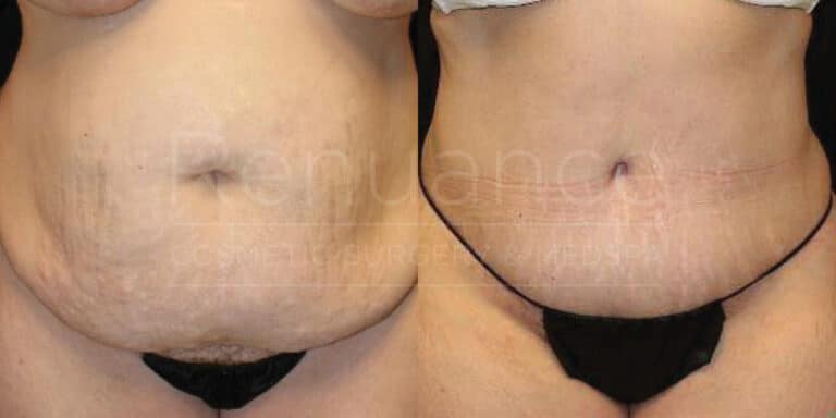 Before and after tummy tuck showing successful outcome