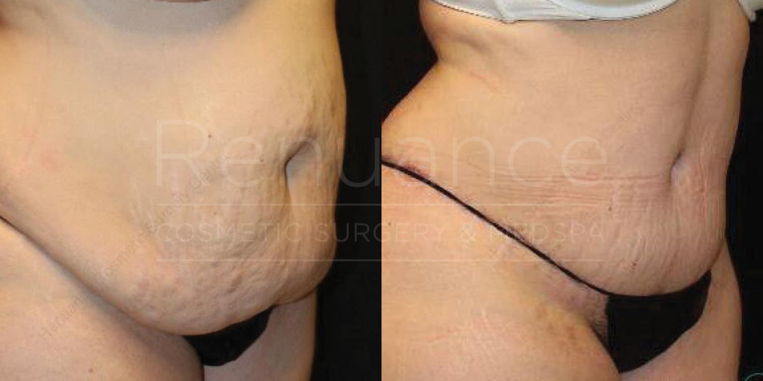 Advanced tummy tuck before and after from our practice