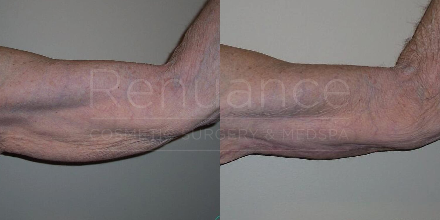 A side-by-side comparison of two images showing the arm of a person. The left image shows the arm with noticeable skin sagging and wrinkles, while the right image shows the same arm after a medical or cosmetic procedure that has tightened the skin and reduced sagging. The images are watermarked with "Renuance Cosmetic Surgery & Medspa."