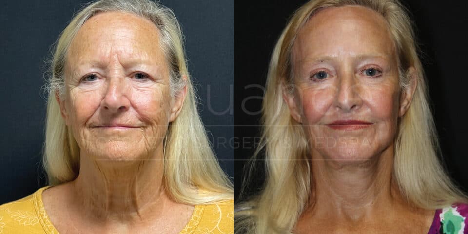 Renuance-Before&After-Facelift-dr-hill-10-07-2024 - (2)