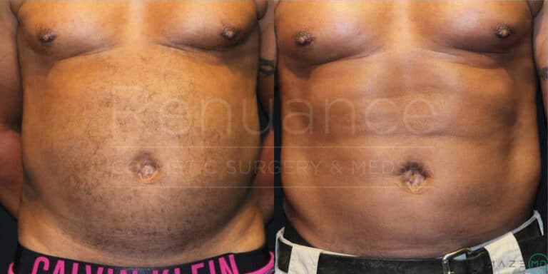 Before and after image of a male torso showing the results of a cosmetic procedure. The left side shows the torso with more abdominal fat and less muscle definition, while the right side shows a more toned and defined abdominal area. The person is wearing different colored underwear in each image. The background is plain and dark.