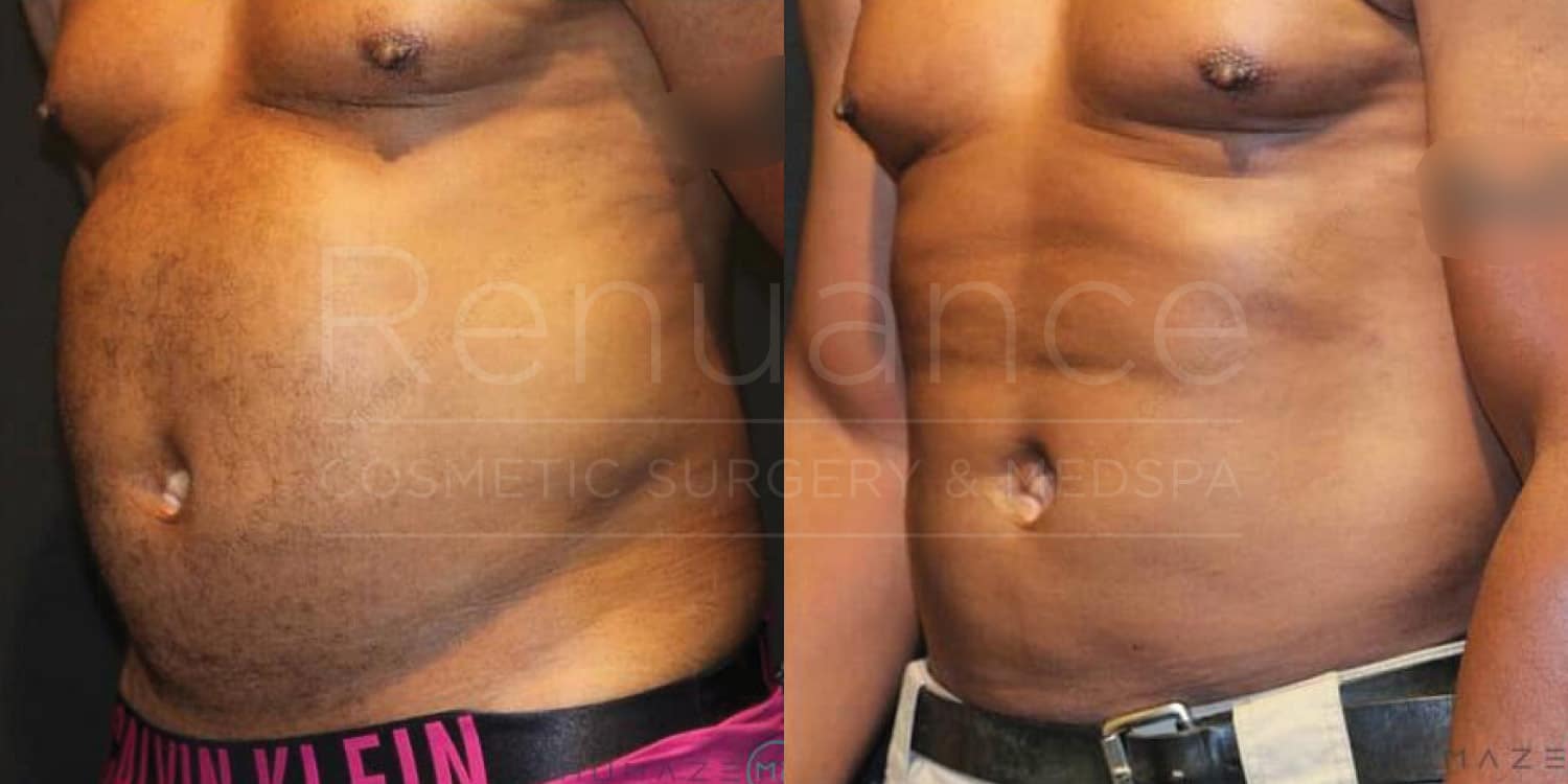 "Before and after images of a male's abdominal area. The left side shows the abdomen before cosmetic surgery, appearing less toned and defined. The right side shows the abdomen after cosmetic surgery, with a more toned and defined appearance. The images have the text 'Renuance Cosmetic Surgery & Med Spa' overlaid."