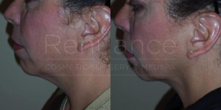 Side-by-side comparison of a woman's profile before and after a cosmetic procedure. The images show improvements in the jawline and neck area. The skin appears smoother and more lifted in the "after" photo. The text "Reliance Cosmetic Surgery & MediSpa" is overlaid on the image.