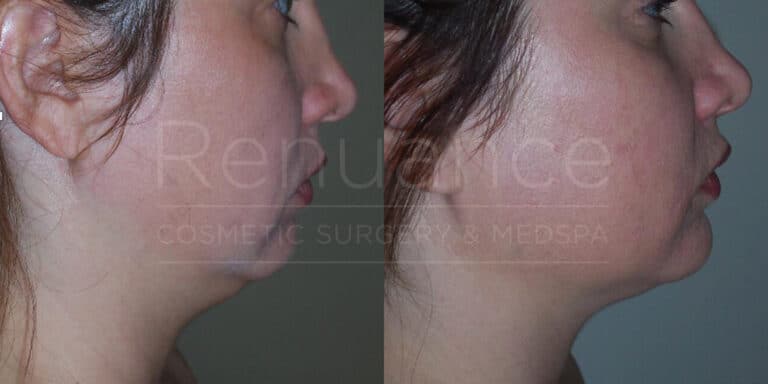 Side-by-side comparison photos of a person's lower face and neck, displaying the differences before and after a cosmetic procedure. The left image shows a profile with more prominent sagging skin under the chin, while the right image shows a tighter and more defined jawline and neck area. The text overlay reads "Rejuvance Cosmetic Surgery & Medspa."