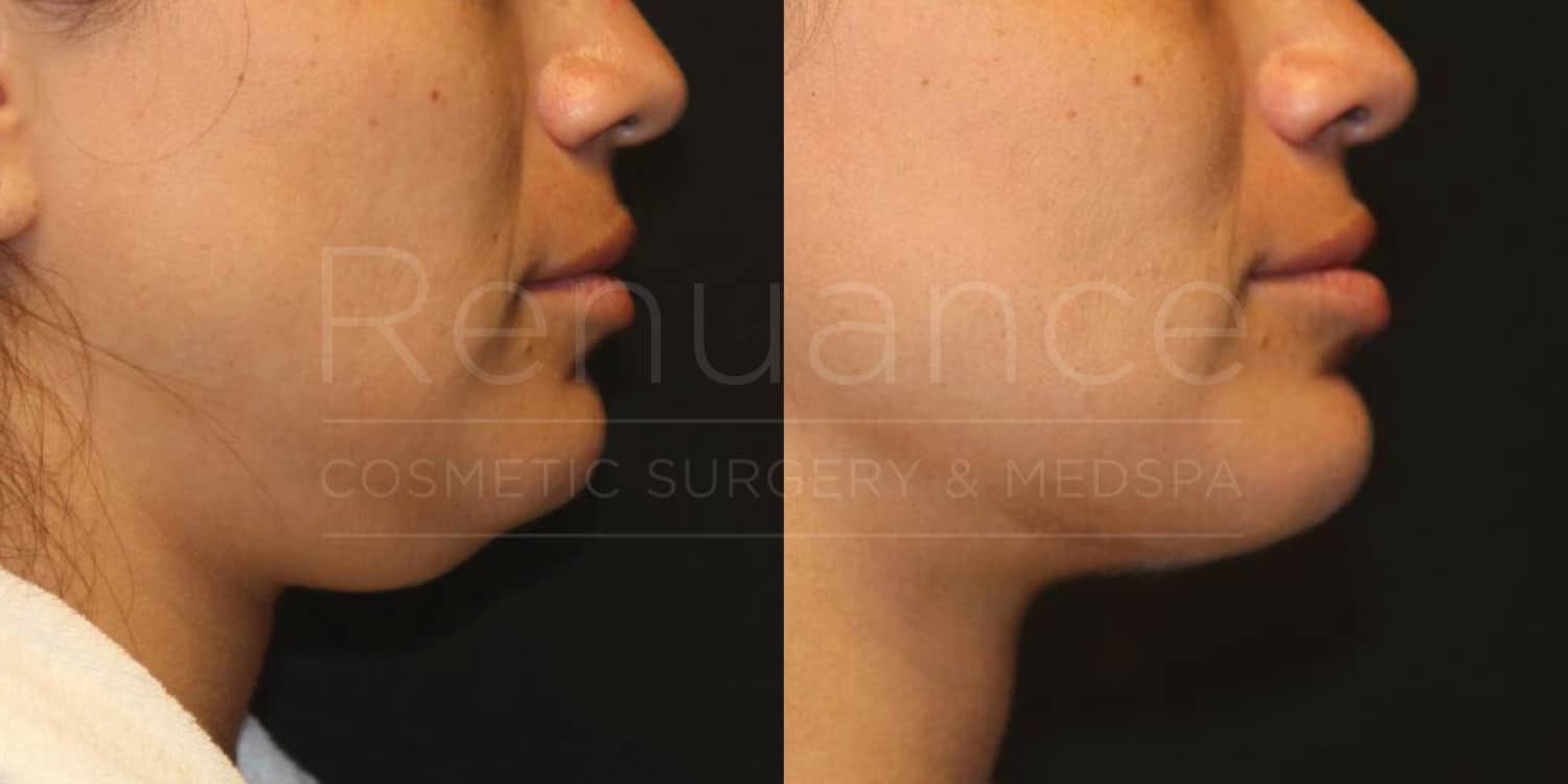 Side-by-side comparison images showing the profile of a person's face before and after a cosmetic procedure. The left image shows the person with a more pronounced double chin. The right image shows the same person with a noticeably reduced double chin, highlighting the results of the procedure. The images have the text "Renuance Cosmetic Surgery & Medspa" overlaid.