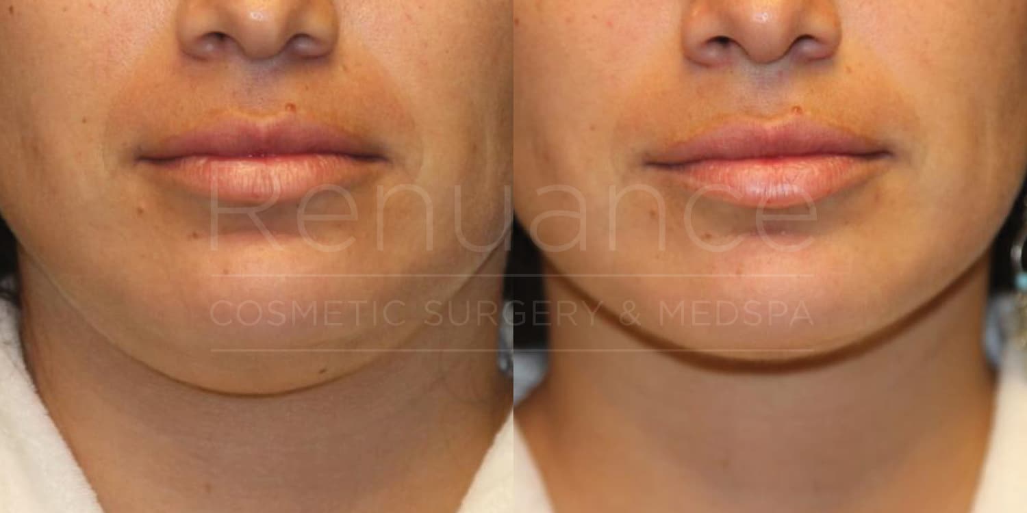 A before-and-after comparison image of a person's lower face. The left side shows the face prior to treatment, with marked pigmentation and some blemishes around the cheeks and lips. The right side shows the face after treatment, revealing smoother and more even skin tone, with a reduction in pigmentation and blemishes. The text "Renuance Cosmetic Surgery & Medspa" is faintly visible across the middle of the image.