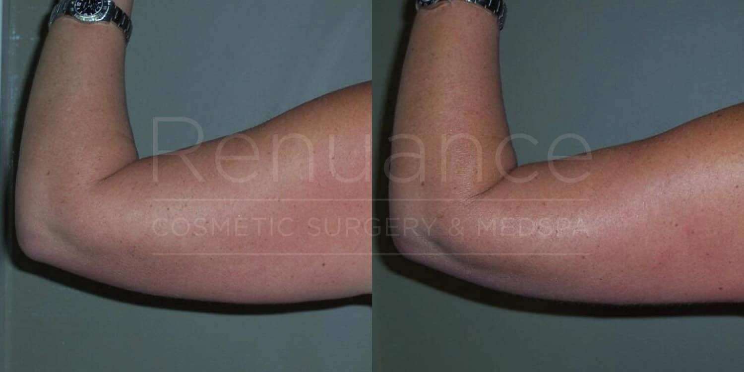 Side-by-side comparison of a person's upper arm showing a before-and-after transformation. On the left, the arm appears fuller, and on the right, the arm looks more toned and slimmer, indicating a possible cosmetic procedure. The words "Renuance Cosmetic Surgery & Med Spa" are faintly visible across the center of the image.