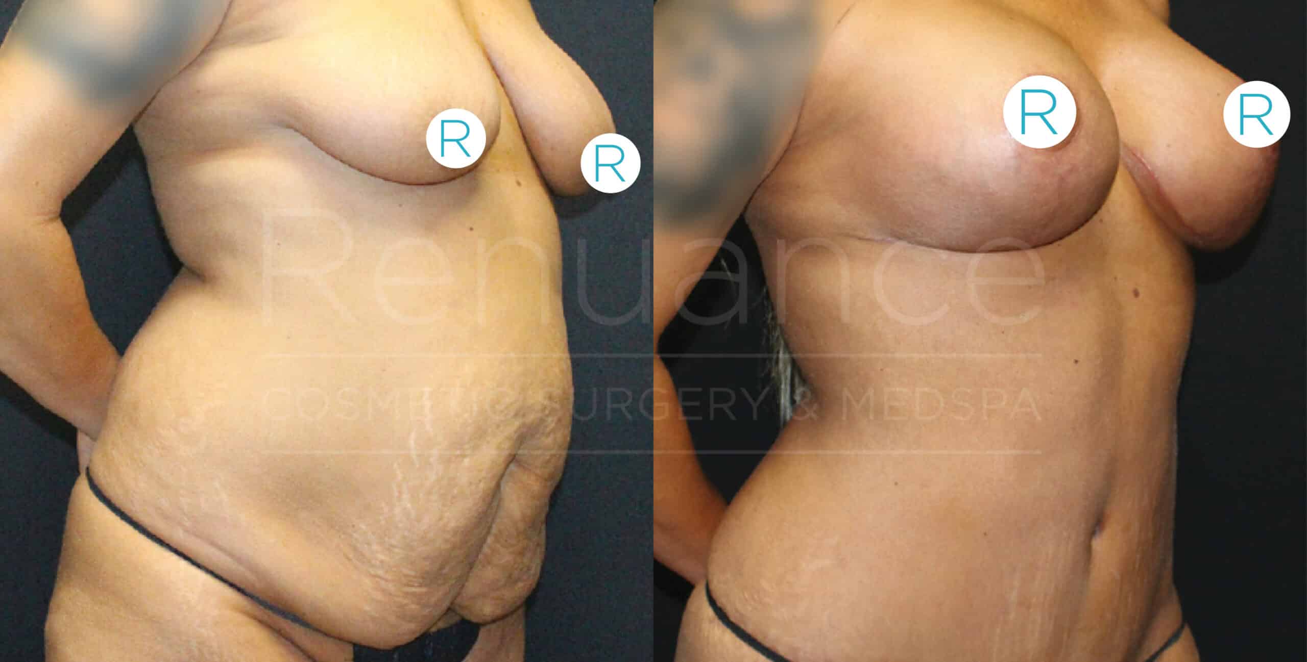 mommy makeover before and after