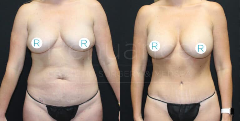 A two-panel image showing the before and after results of a woman's cosmetic surgery. In both panels, the woman is standing against a black background wearing minimal clothing to reveal the changes. The left image shows the woman before the surgery, with visible abdominal and breast features. The right image shows the woman after the surgery, with a noticeably slimmer midsection and enhanced breast appearance. White circular stickers with the letter "R" cover the nipples in both photographs.