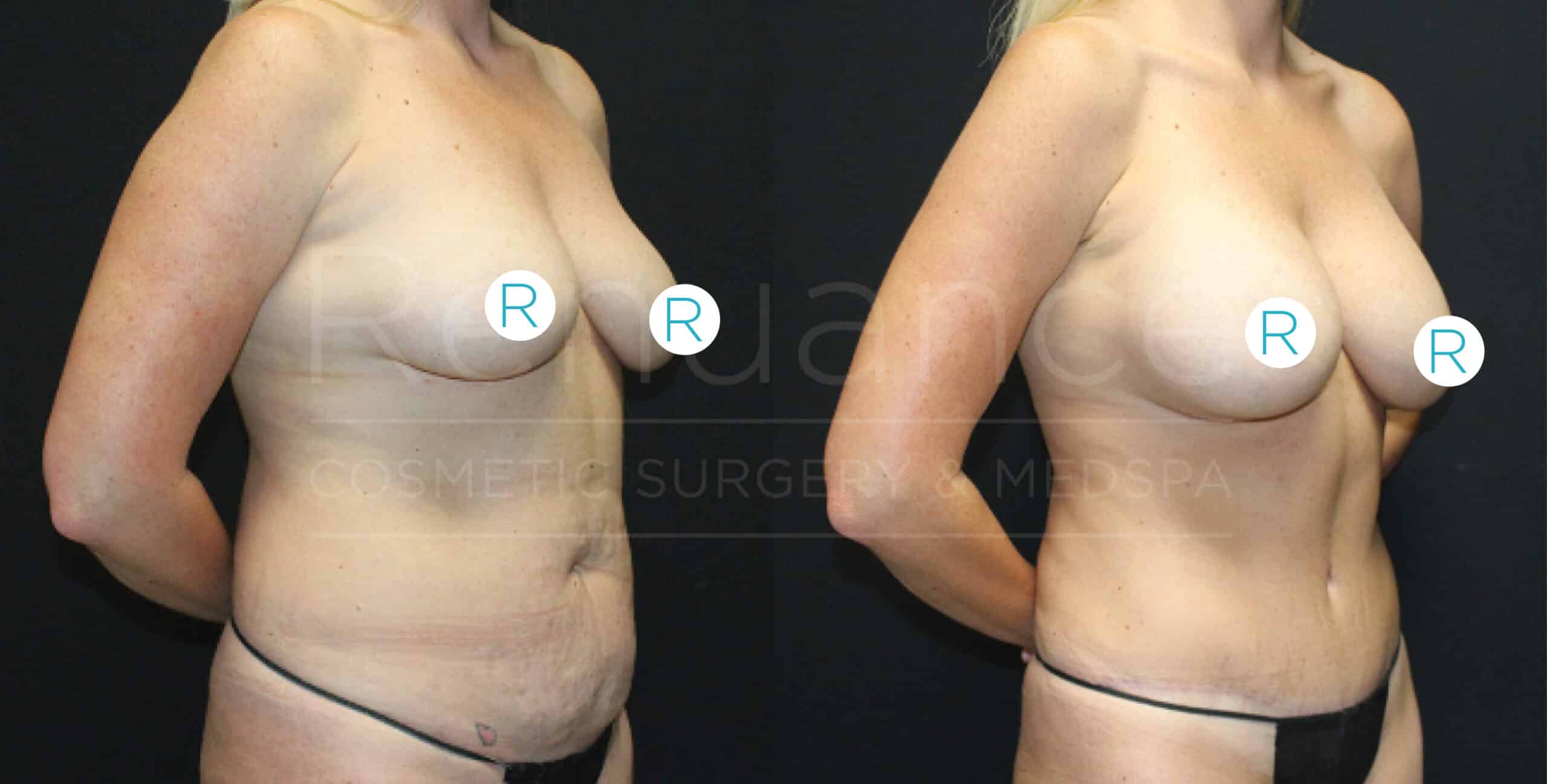 The image displays a side-by-side comparison of a woman's body before and after a cosmetic surgery procedure. The left side shows the woman before the surgery, and the right side shows the woman's body after the surgery, highlighting noticeable changes in her figure. Both images have the woman's hands placed behind her back.